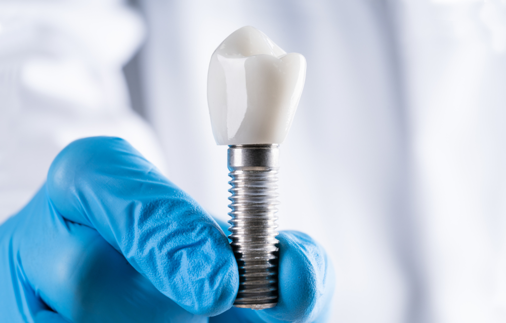 От чего зависит качественная имплантация зубов?