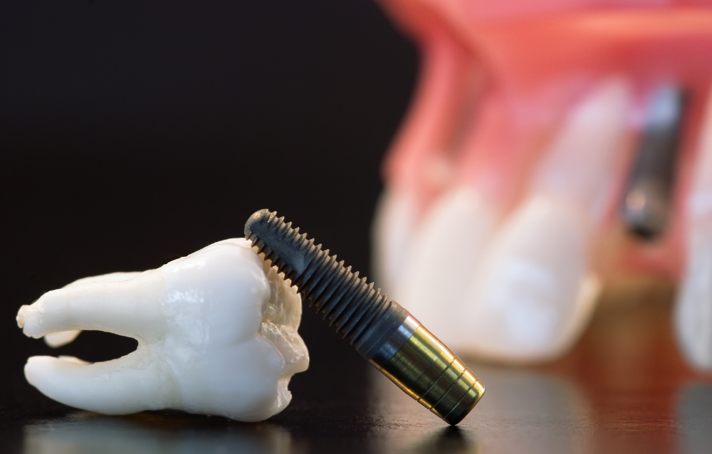 Как выбрать зубные импланты?