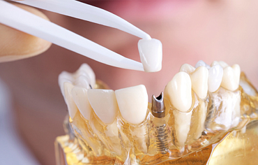 Главный вопрос имплантации зубов — приживется или нет?