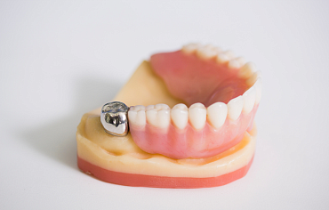 Как подготовить зубы к протезированию?
